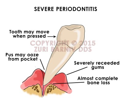Severe perio|409x318